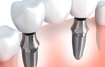 Dental implants